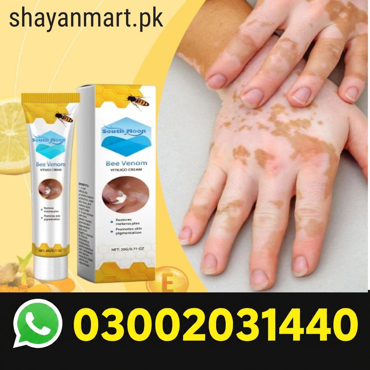South Moon Bee Venom Vitiligo Cream In Pakistan