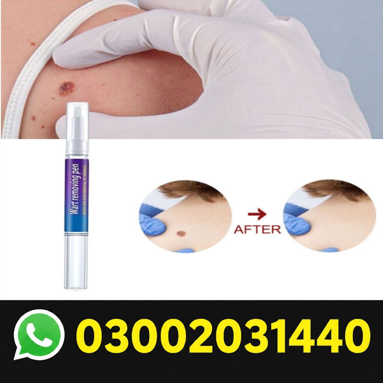 Wart Removing Pen